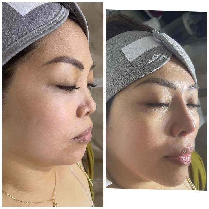 Hiko Nose Lift