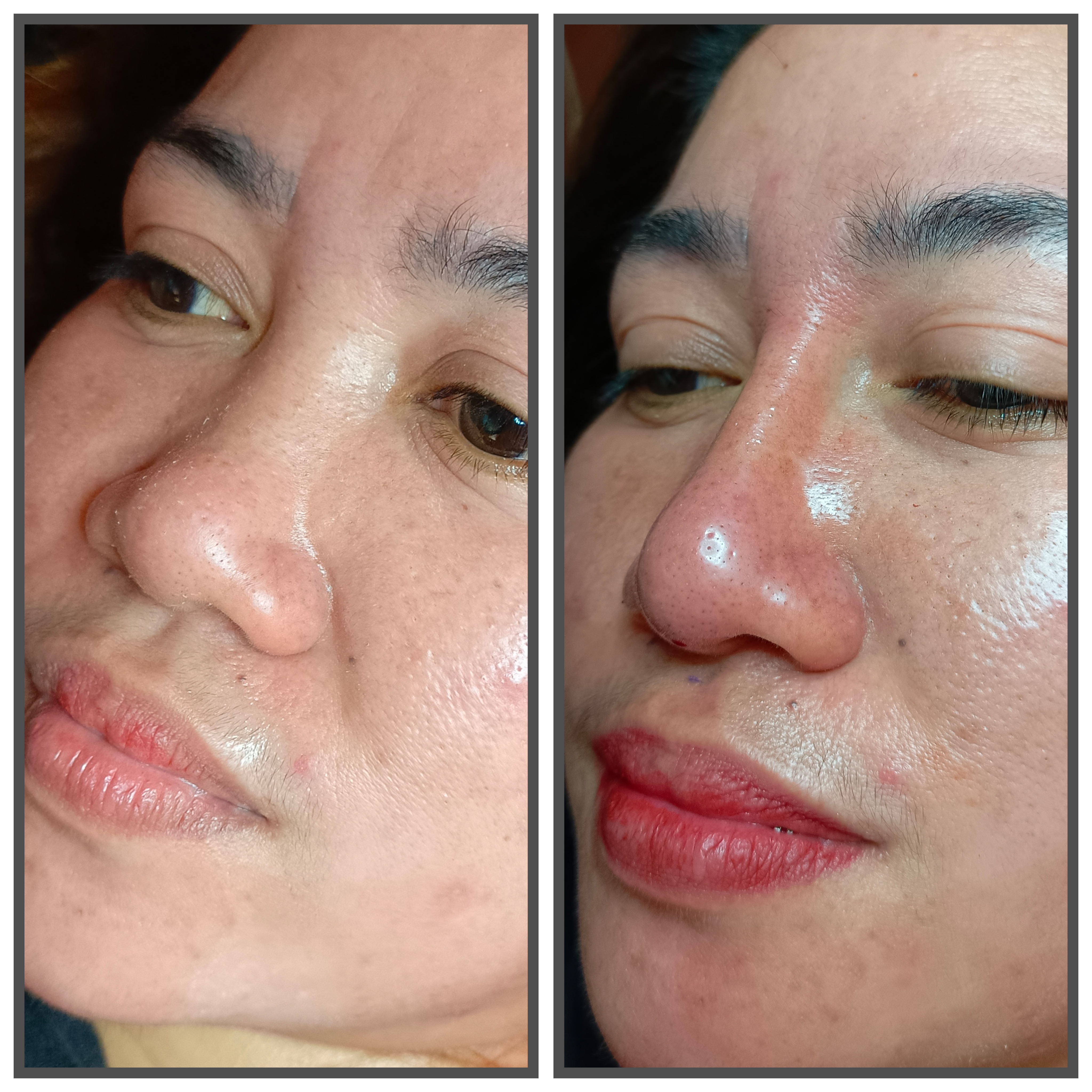 Hiko Nose Lift