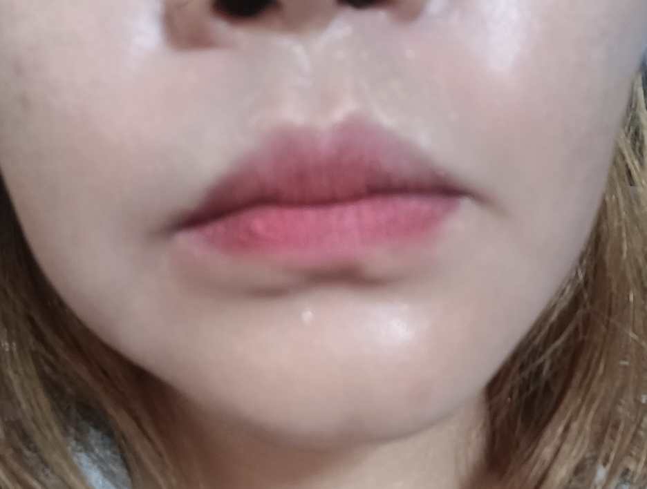 Lip Fillers