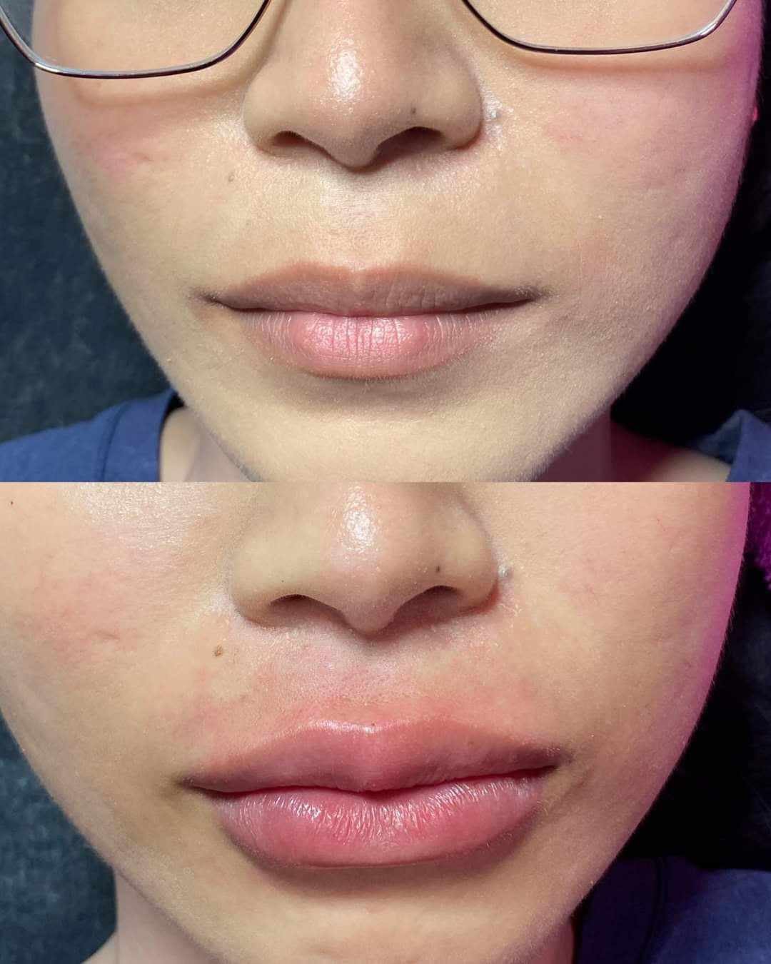 Lip Fillers