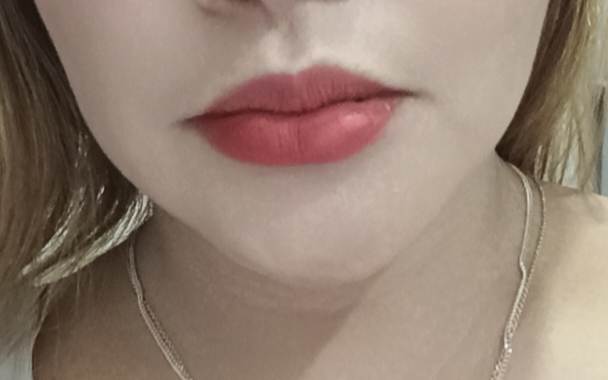 Lip Fillers