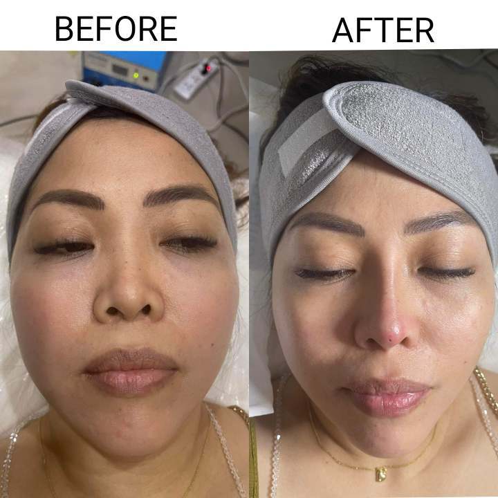 Hiko Nose Lift