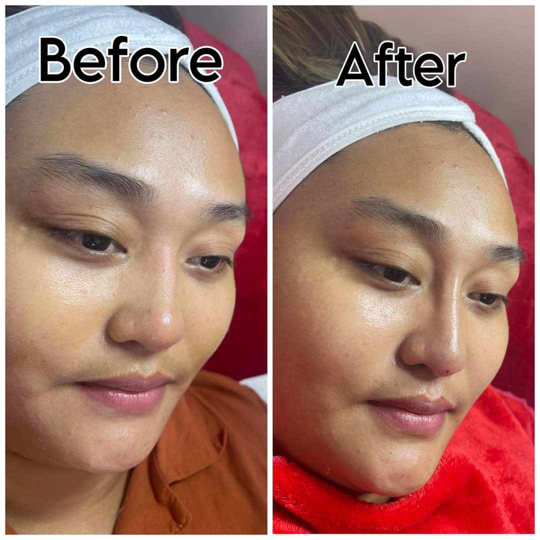 Hiko Nose Lift
